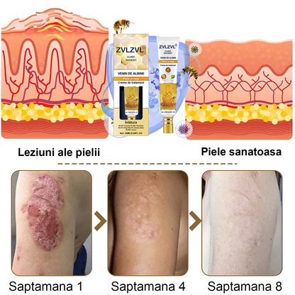 ZVLZVL®  Venin de Albine Alunițe Negii Tratament Crema (👨‍⚕AAD RECOMANDĂ)
