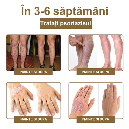 ZVLZVL®  Venin de Albine Alunițe Negii Tratament Crema (👨‍⚕AAD RECOMANDĂ)