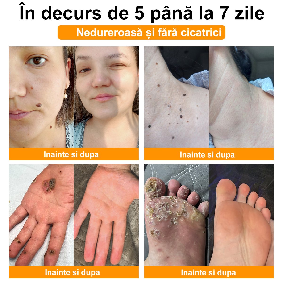 ZVLZVL®  Venin de Albine Alunițe Negii Tratament Crema (👨‍⚕AAD RECOMANDĂ)