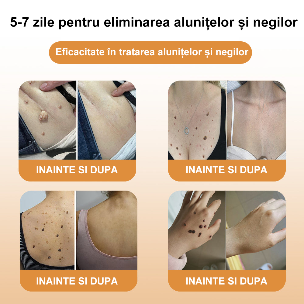 ZVLZVL®  Venin de Albine Alunițe Negii Tratament Crema (👨‍⚕AAD RECOMANDĂ)